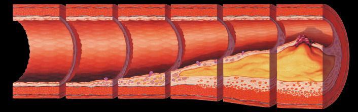 Foam Cells Atherosclerosis Timeline Fatty Streak Intermediate