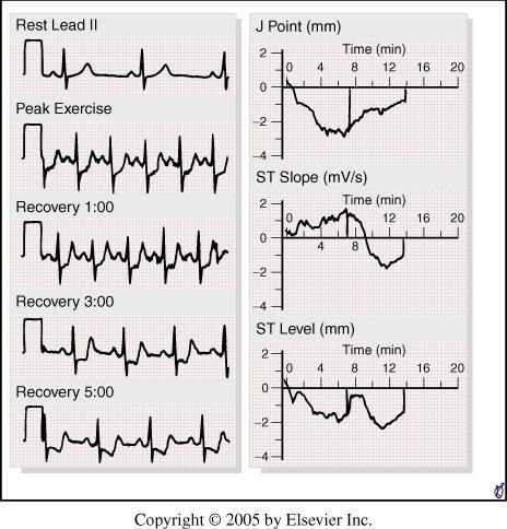 Bruce protocol. In this type of ischemic pattern, the J point at peak exertion is depressed 2.