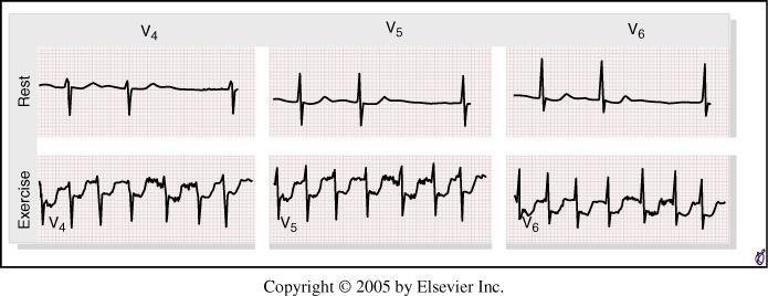 A 75-year-old woman with chronic atrial fibrillation and a 6-month history of atypical chest pain