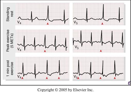 61-year-old man with atypical angina and a hiatal hernia was referred for diagnostic exercise testing.