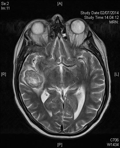 Manchester Patient Case 1 : 49 yr old male, 10 pack year smoking history MRI brain July 2014 July 2013: T2N1M1b ALK + ADC lung, bone & lung mets Cis/pem 4 cycles : PR Mar 2014 : PD lung & brain