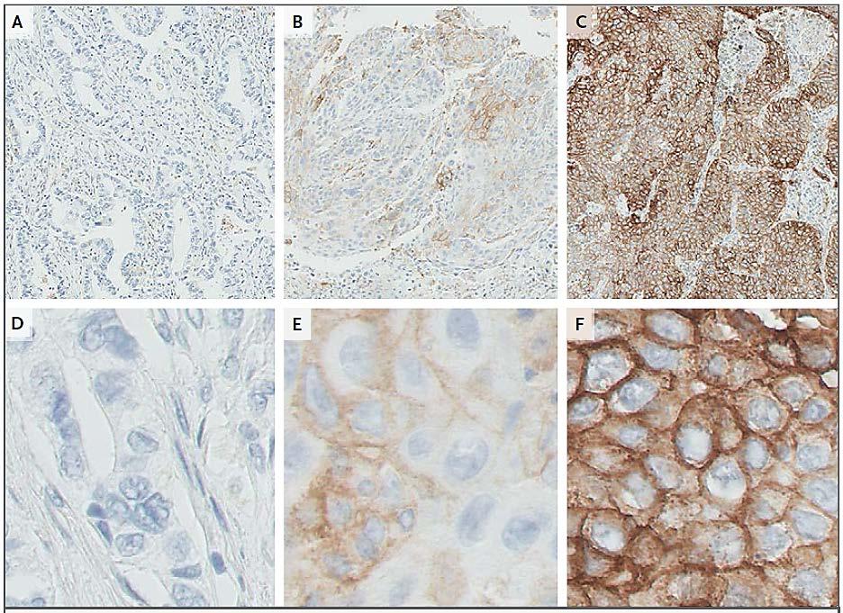 Biomarker Analysis 025 Anti-PD-L1 antibody clone 22C3 (Merck) and a prototype IHC assay used to determine PD-L1 status/expression in contemporaneous biopsy samples PD-L1 positivity was defined as