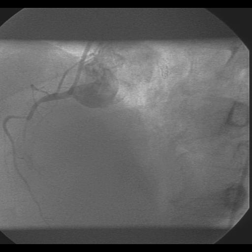 Figure 1. The occluded right coronary artery before emergency primary PCI. Figure 2.