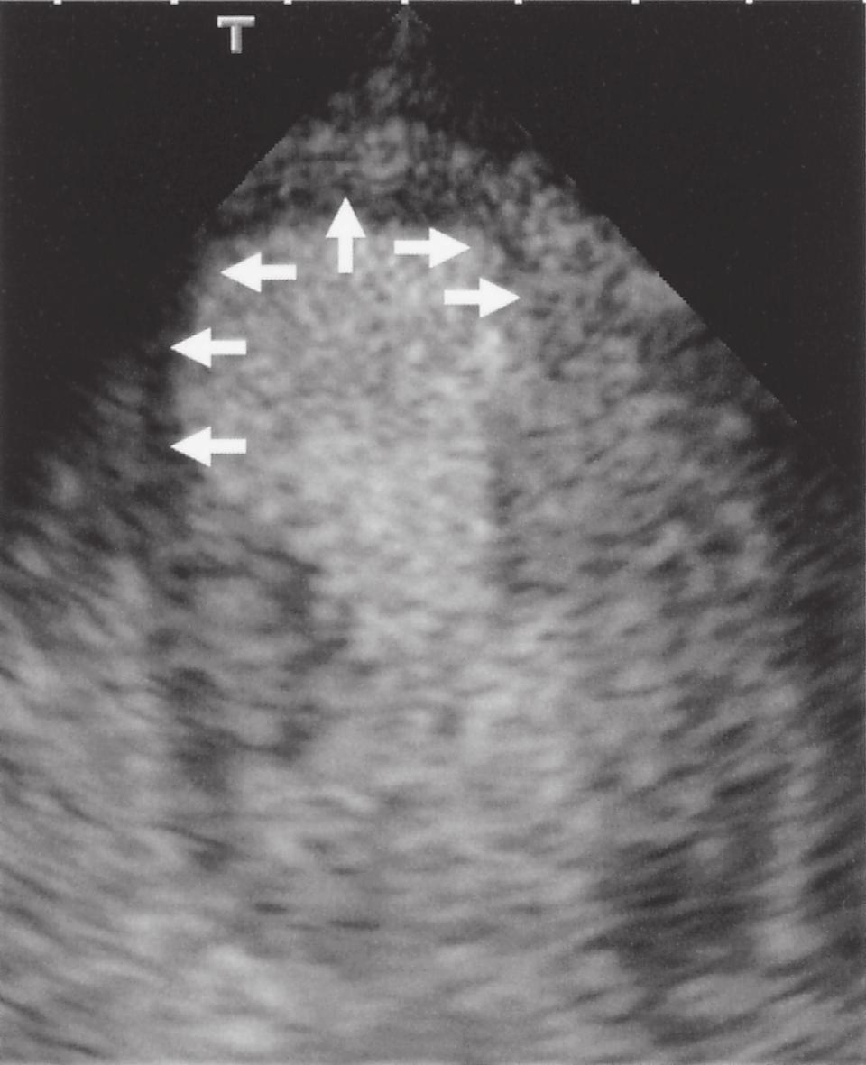 In the normal subject, all of the left ventricular myocardium shows contrast enhancement.
