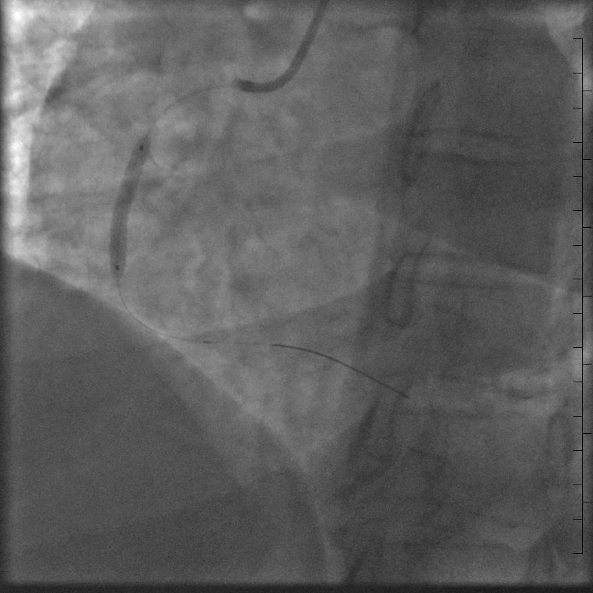 Inferior STEMI Artery