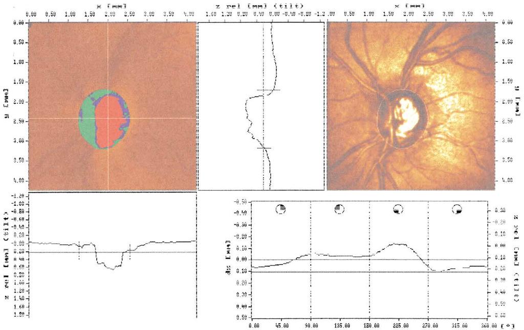 S308 Surv Ophthalmol 45 (Suppl 3) May 2001 BLUMENTHAL AND WEINREB derlying remainder of the retina, a RNFL thickness map is then constructed.