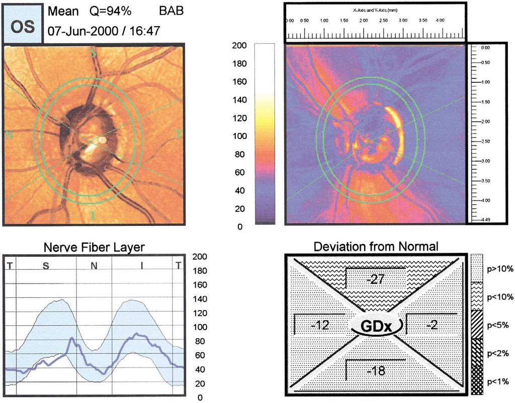 ASSESSMENT OF THE RETINAL NERVE FIBER LAYER S309 Fig. 2. A scanning laser polarimeter printout of a glaucoma patient showing marked RNFL loss superiorly (GDx). cation (Fig. 2).