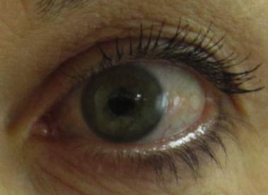 n Painful L eye, vision reduced to 6/18 from 6/5 n