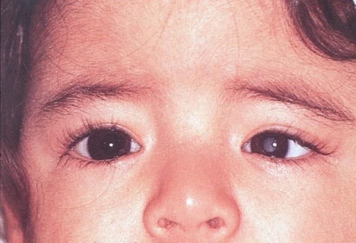 Strabismus - treating amblyopia prior to surgery improves
