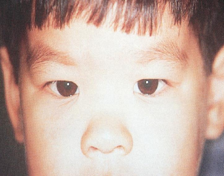 Pseudoesotropia Broad epicanthic folds Medial sclera is