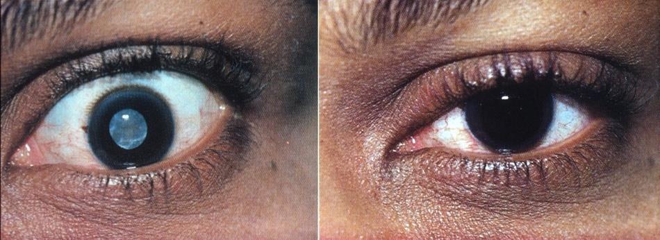 : glaucoma, metabolic, trauma Aqueous and vitreous e.g.: uveitis Lens e.