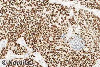 1a & 2a. Virtually all neoplastic cells show a moderate to strong nuclear staining reaction. No background staining is seen. Fig.