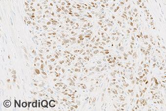 Fig. 4a (x200) Optimal GATA3 staining of the urothelial carcinoma using same protocol as in Figs. 1a - 3a.