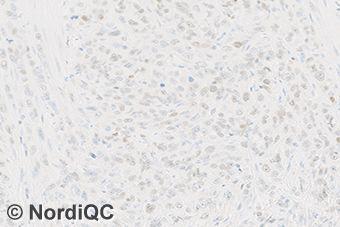 4b (x200) Insufficient GATA3 staining of the urothelial carcinoma using same protocol as in Figs. 1b 3b same field as in Fig. 4a.