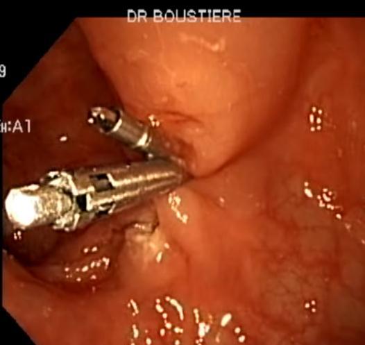 polyps > 1cm, - adrenaline injection is