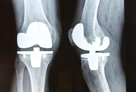 Joint replacement 15% severe pain post TKR, 6% severe pain post THR at 3 yrs Wylde V. et al.