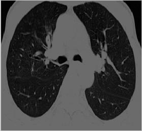 extraction of lung region. Then for segmentation Fuzzy Possibilistic C Mean (FPCM) algorithm is used and for learning and classification Extreme Learning Machine (ELM) is used.