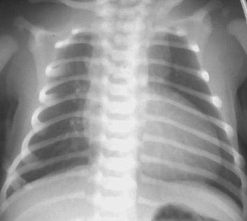 30 Part 2: Cases Acquired respiratory disorder: Baby Smith may have a chest infection, or bronchiolitis, but the lack of respiratory symptoms makes this unlikely.