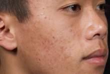 and comedonal acne, with significant improvement in as little as 2 weeks.