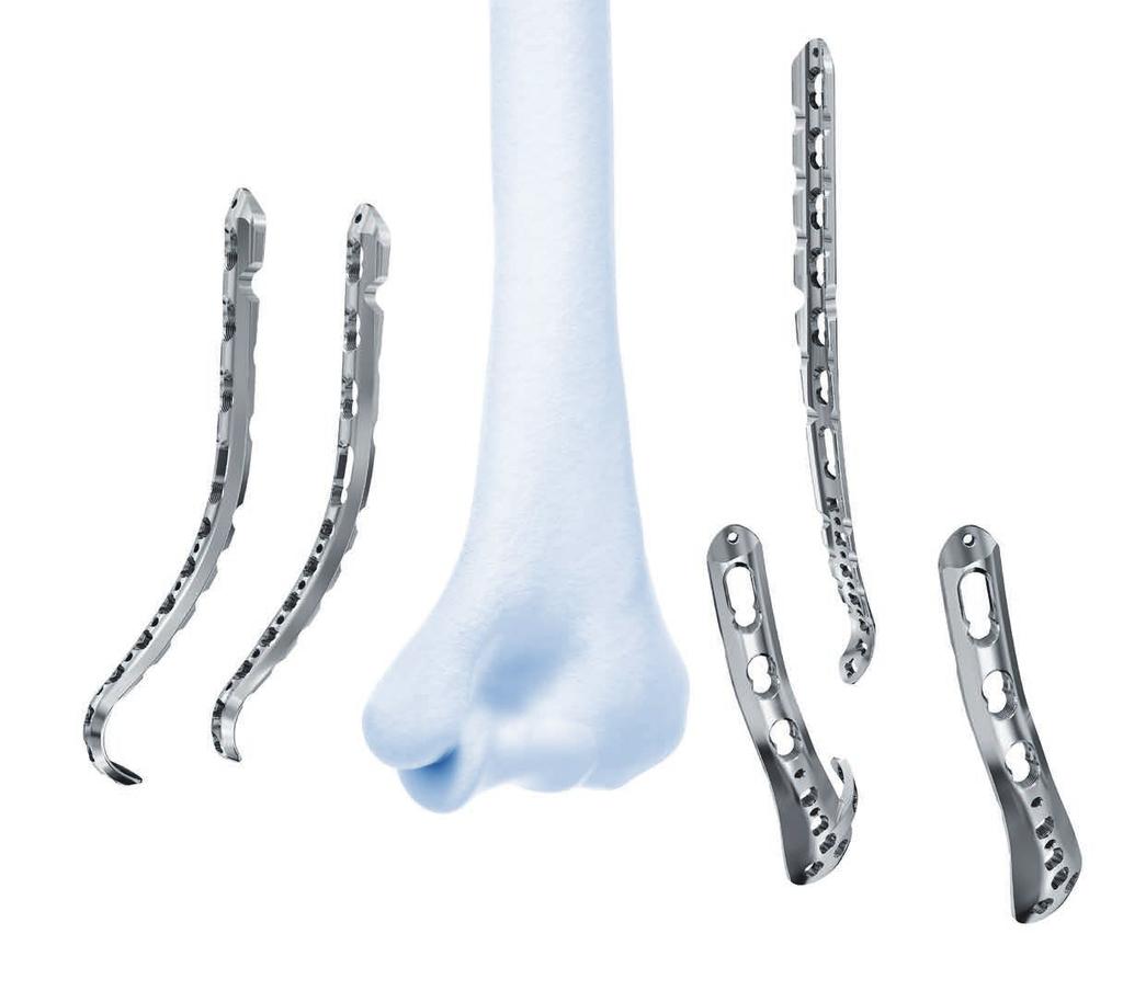 VA-LCP Distal Humerus Plates The plates offer multiple screw configurations for the medial and lateral columns, and the articular block. 3 2 1 5 4 1 Medial Plate The standard medial column plate.