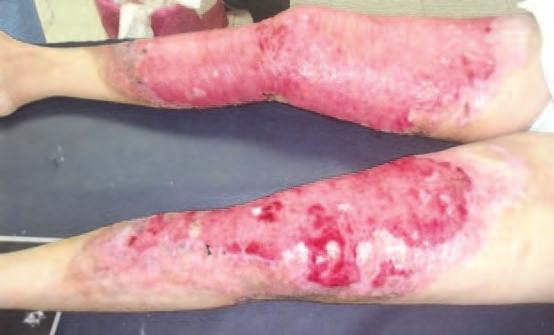 Fig. 1. Deep full thickness burns of both lower limbs and after reconstruction with STSG. 3.2 Post traumatic skin loss Friction burns ((fig.