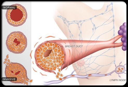 This type of cancer is known as HER2-positive, and it tends to spread faster than other forms of breast cancer.
