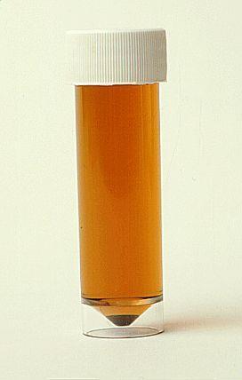 The most common symptoms of rhabdomyolysis include: dark urine