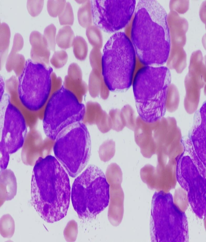 Acute Promyelocytic Leukemia Distinguishing Features 10-15% of adult AML Leukopenia (85%) Complex coagulopathy t(15;17) chrom