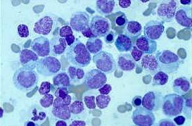 leukemic promyelocytes to