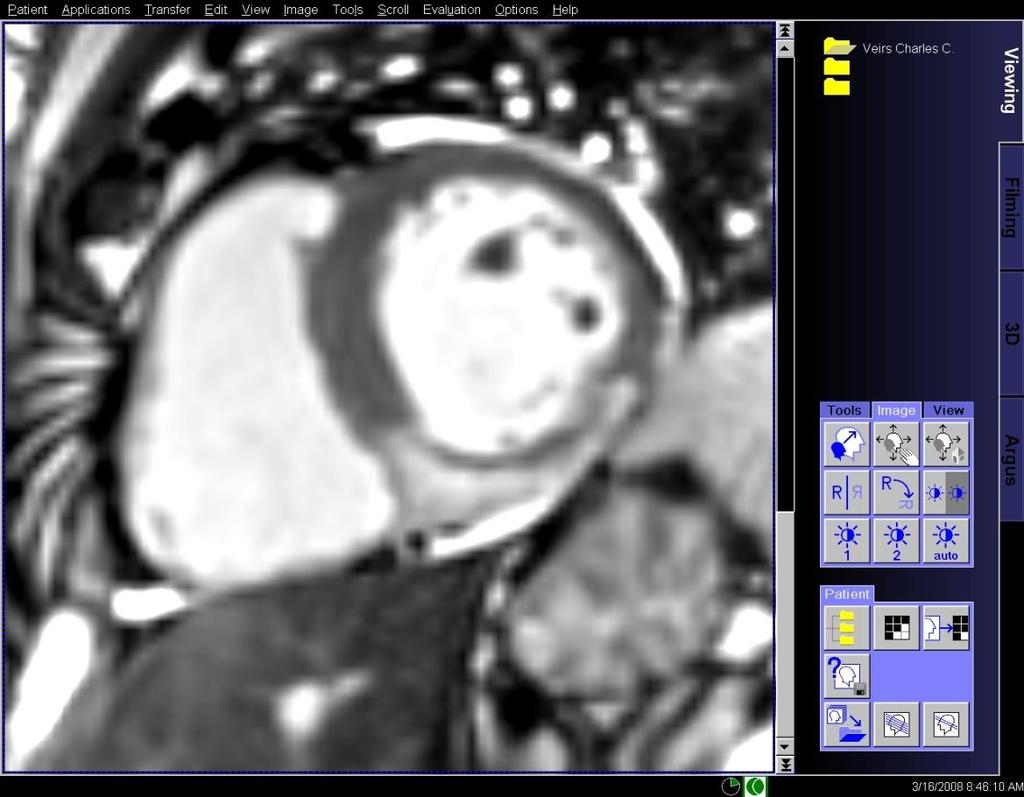 MRI reveals cardiac pathology T2-Oedema MRI