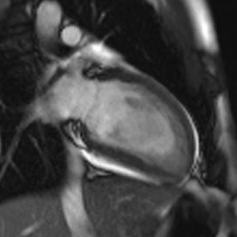 Day 2 MRI reveals extensive scar and MVO Contrast MRI MVO Late