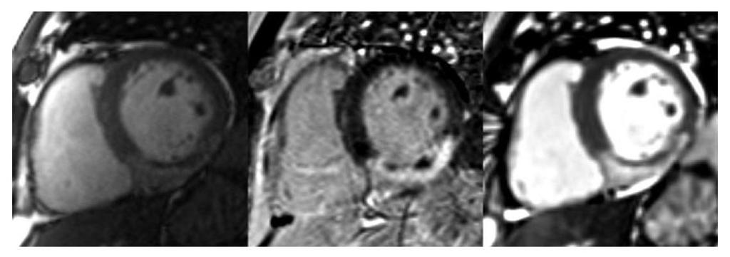 T 2 MRI delineates the areaat-risk & myocardial salvage Cine late gadolinium T 2 MRI scar