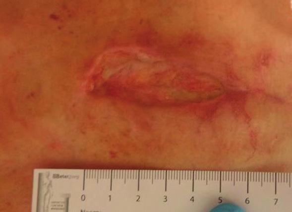 CASE 3: DEHISCENCE TO A STERNUM WOUND FOLLOWING CARDIAC SURGERY Author: Alita Jaspar, MSc in Wound Healing & Tissue Repair, RN Expertise Centrum Wondzorg, The Netherlands INTRODUCTION This is a