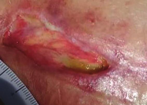 The wound had been present for 1 month prior to commencement of BIOSORB Dressing. The patient had previously been treated with topical NPWT, with twice-weekly dressing changes.