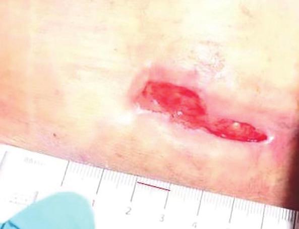 The dressing was easy to remove and intact despite high exudate levels. The clinician and patient were both satisfied, with dressing changes reduced from thrice- to twice-weekly.