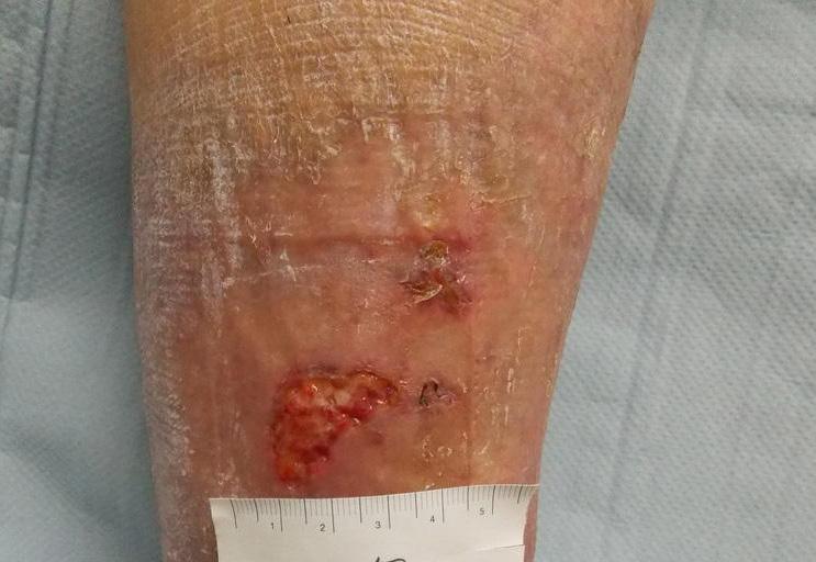 The wound had previously been treated with a hydro-desloughing dressing. At baseline, the wound measured 2.5cm (length) x 2.0 cm (width), with no depth (Figure 1).