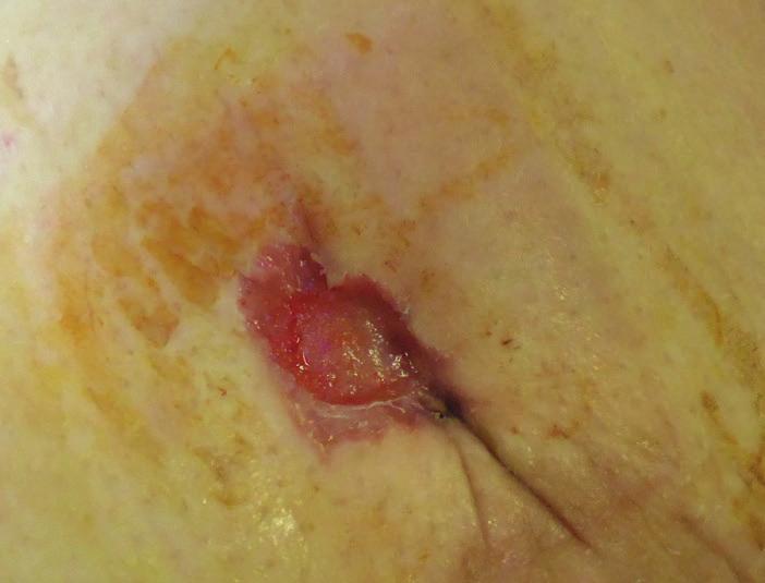 BIOSORB Dressing had provided excellent comfort during wear and stayed intact on removal. The clinician reported excellent ability to handle exudate and conform to the wound bed.