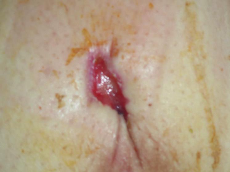 BIOSORB Dressing and TIELLE ESSENTIAL Silicone Border Dressing were reapplied, with excellent ease of application. Review 3: After another 5 days, the wound measured 1.2cm x 2.