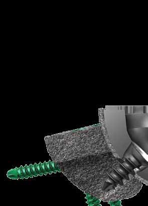 Advanced Fixation Locking Screw Option GRIPTION TF implants have the ability to use locking screws to fixate the Augment or Advanced