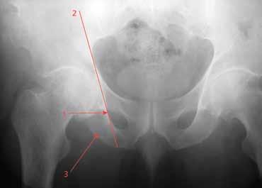 Key Bone Stock and Landmark Considerations Radiographic landmarks can be helpful in assessing the acetabular bone stock.