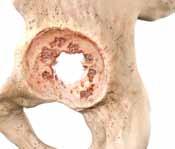 supportive Greater than 70 percent of host bone to