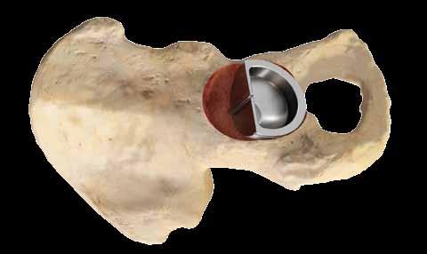 Acetabular Preparation Continued Modular Rasp Technique Once the acetabular cavity has been prepared, utilize the half shell trial that is undersized by 1mm from the last reamer or acetabular