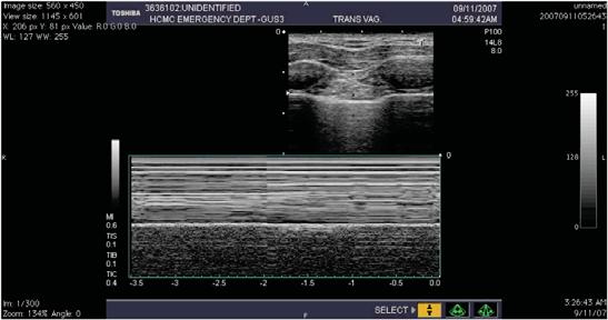 Thoracic Ultrasound -Sliding Lung Sign- Sliding Lung Sign -M Mode- Thoracic Ultrasound -Lichtenstein et al (10)- Ultrasound was a sensitive test for detection of pneumothorax, although false-positive
