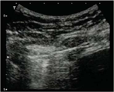 Comet Tail Artifact Thoracic Ultrasound -Comet Tail Artifact- Artifact perpendicular to the pleura casting a hyperechoic line into the lung parenchyma Normally seen in fully expanded lung Can also be