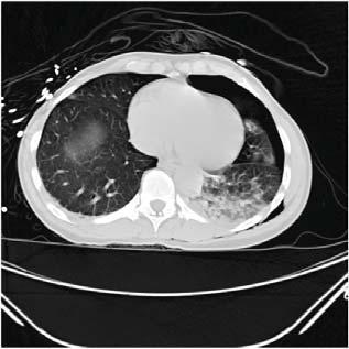 EFAST -A Case- Quiz! The most common place to see free fluid in the left upper quadrant is: A. Between the spleen and the kidney B. Between the spleen and the diaphragm C.