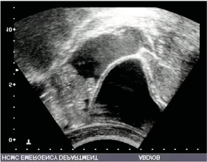 this space because of the phrenicocolic ligament running in this area Fluid commonly collects around