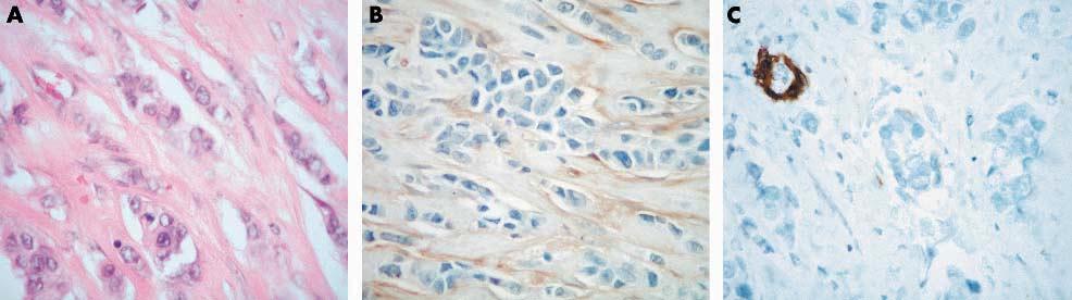 CD10, SMMHC, and breast myoepithelial cells 627 Table 2 Immunohistochemical results of DCIS Antigen 3+ complete* 3+ partial 2+ complete 2+ partial* 2+ focal 1+ complete* 1+ partial* 1+ focal* 0* CD10