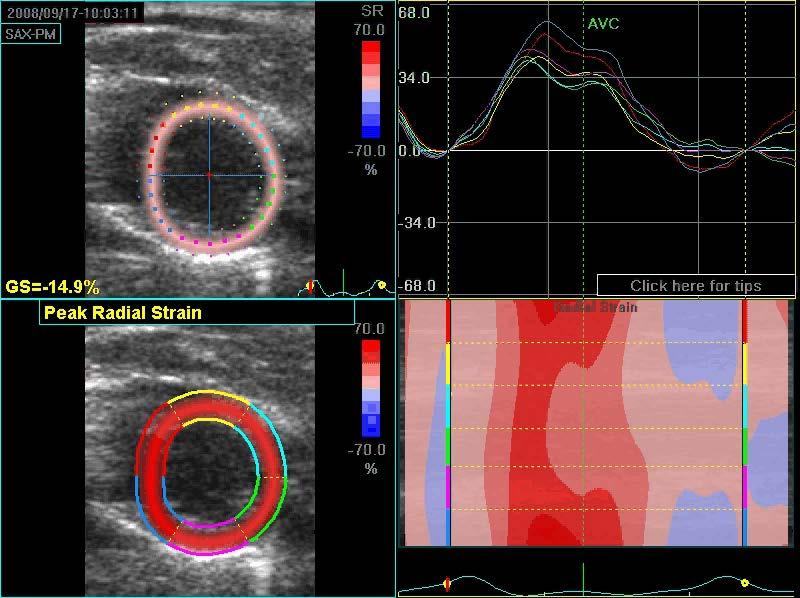 Regional Strain, and Strain Rate Imaging Early Detection of regional dysfunction Rat Ischemia