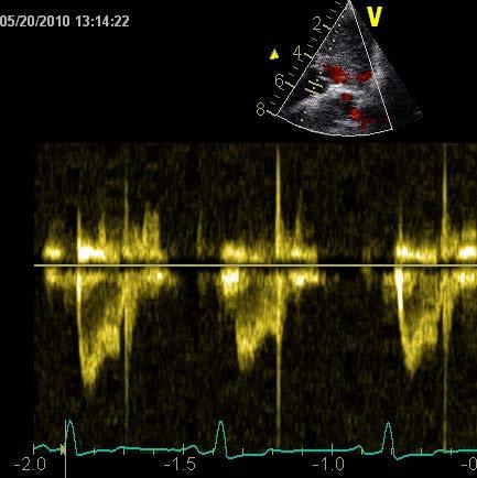 Doppler Velocity encoding MRI Human