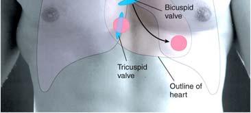 The first heart sound (lub) occurs as A-V valves